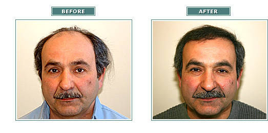 beforeafter_angelo