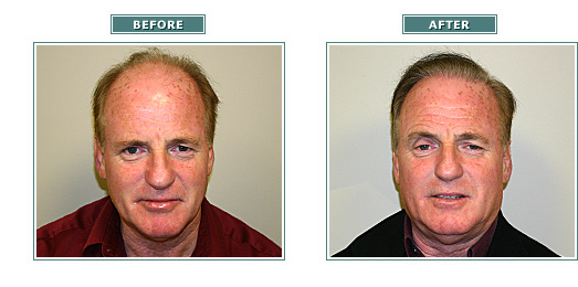 beforeafter_bobv