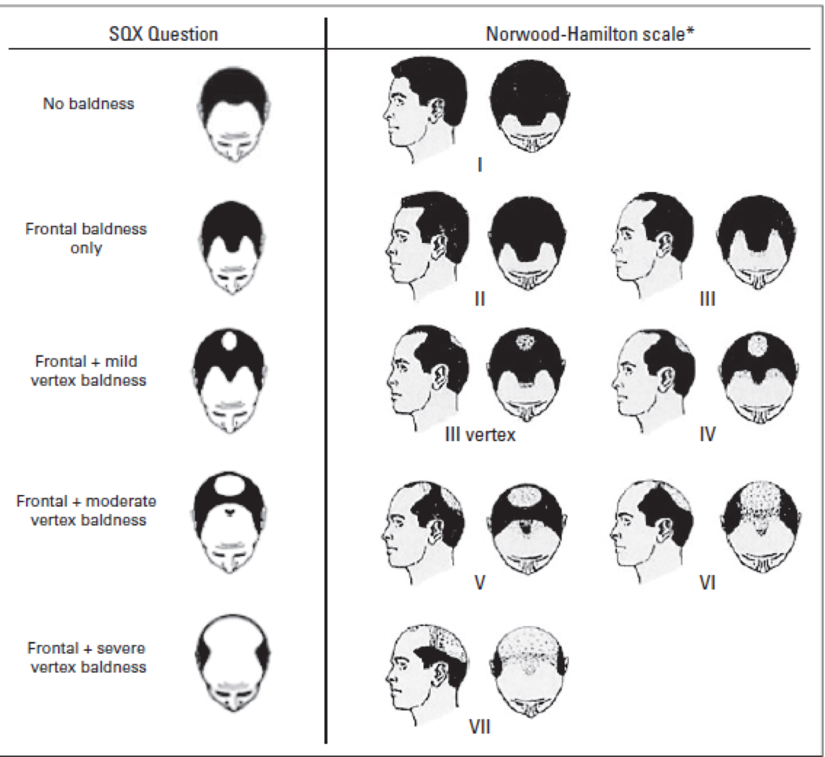 What Is Male Pattern Baldness Cool Design Ideas What Is Male Pattern Baldness Cool Design Ideas