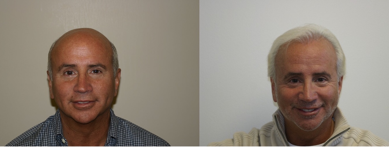 Common questions after a hair transplant Common questions after a hair transplant