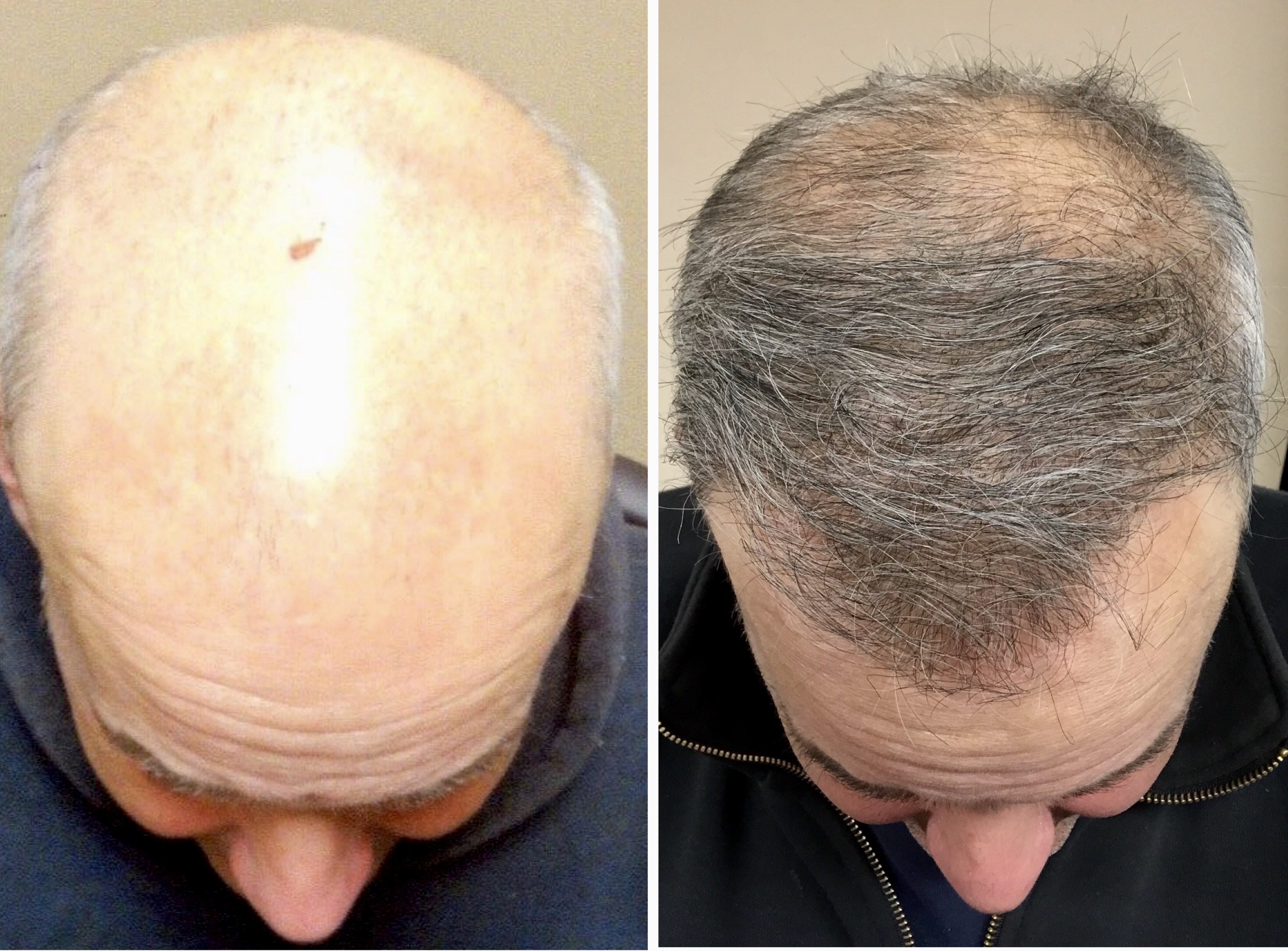 Hair Transplant Surgery in Los Angeles - DermHair Clinic - 1-310-318-1500