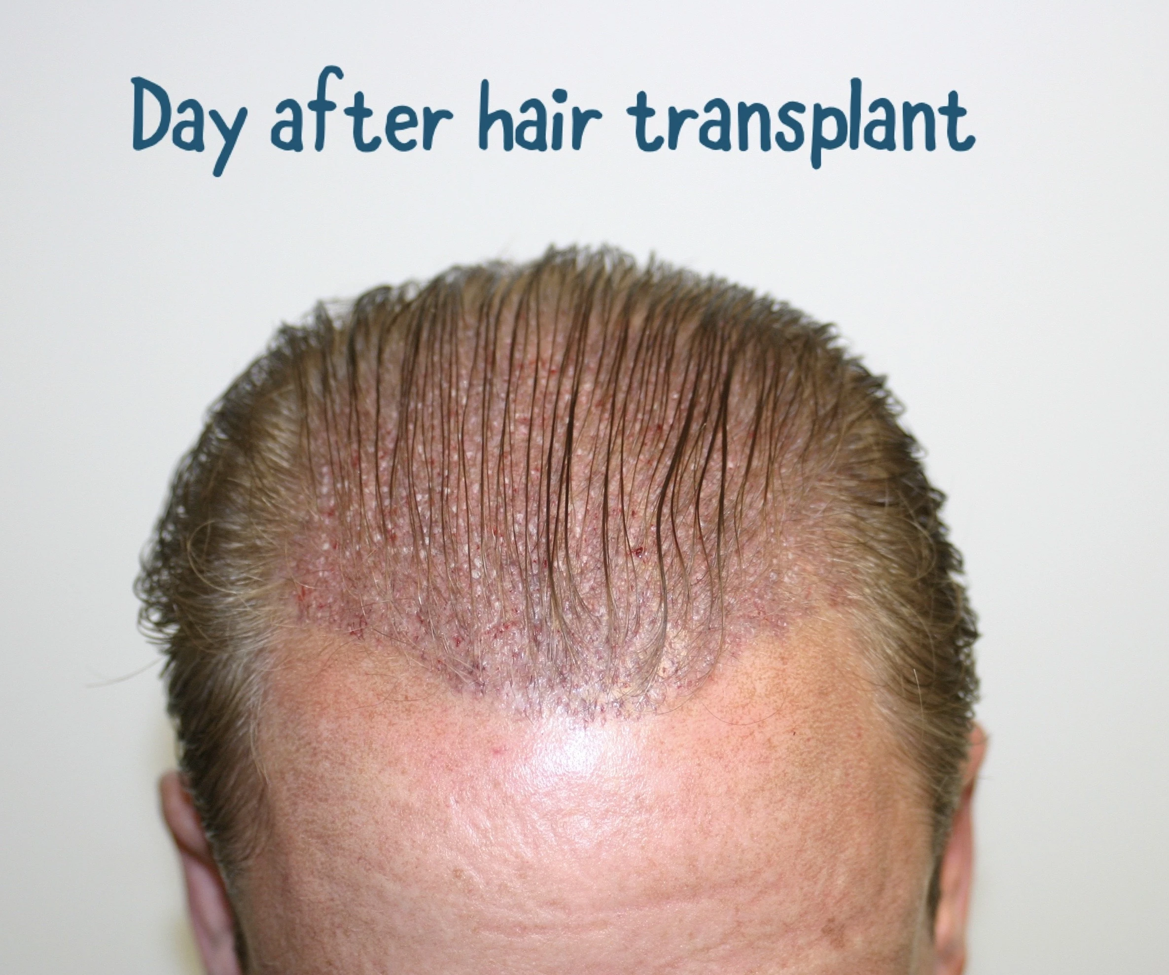 Important Steps to Follow After a Hair Transplant
