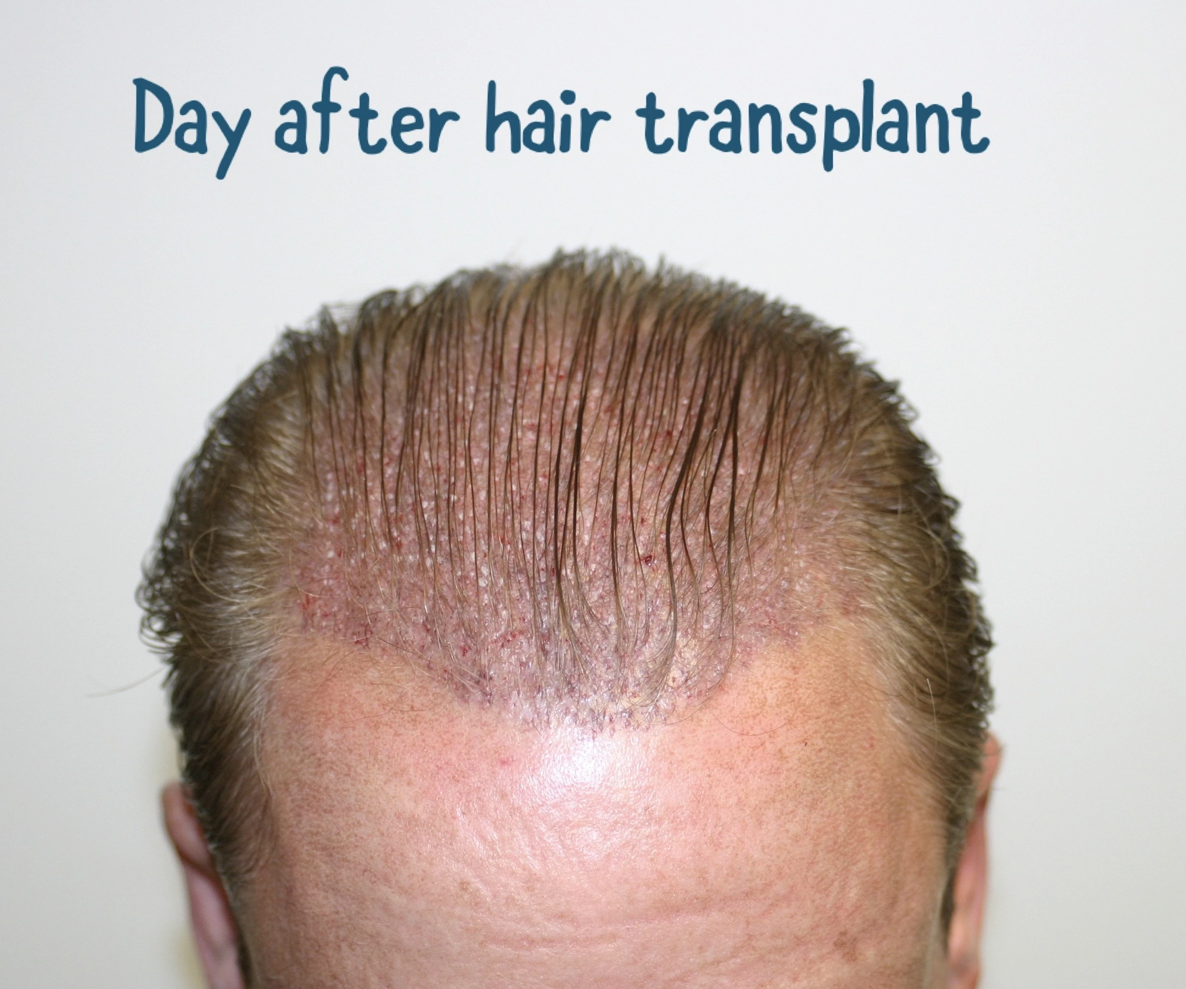 Hair Transplant in Surat Results Hair Transplant Surgeon in Surat