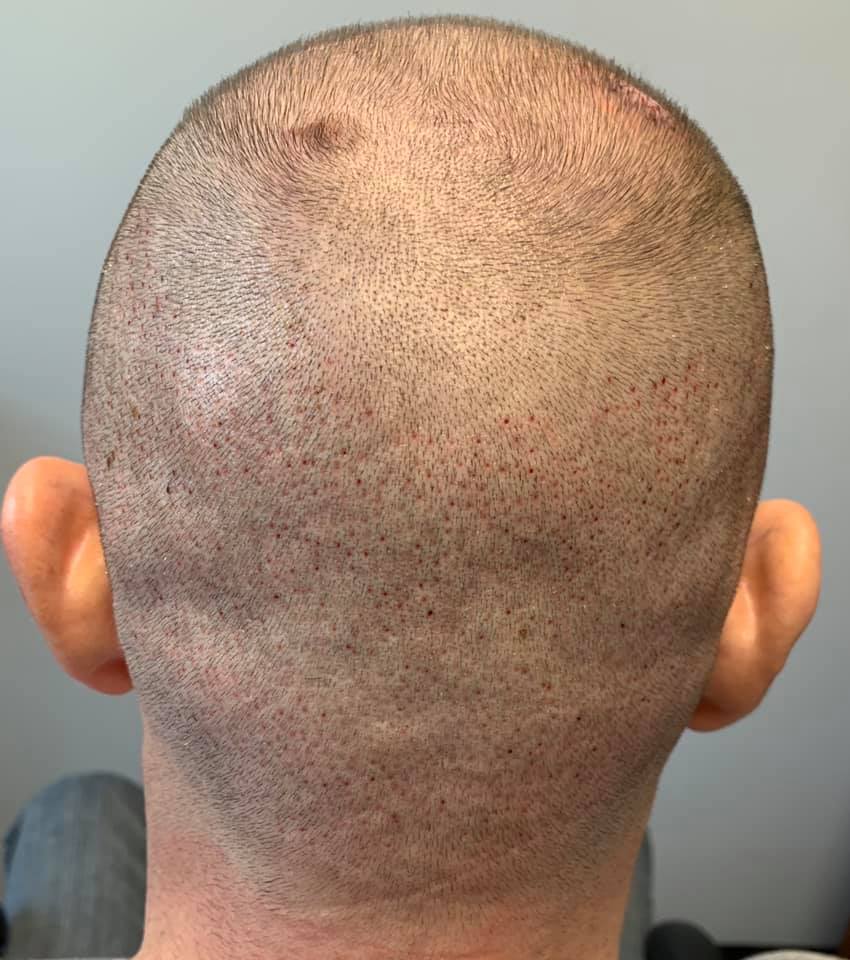FUE Donor Site Day After Hair Transplant