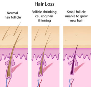 Hair Loss