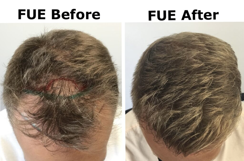 Hairraising Decisions FUT vs. FUE Hair Transplants Examined